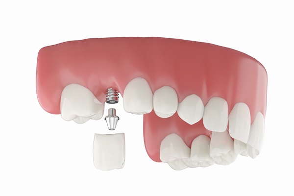 Implant Dentistry: The Single Tooth Replacement Process